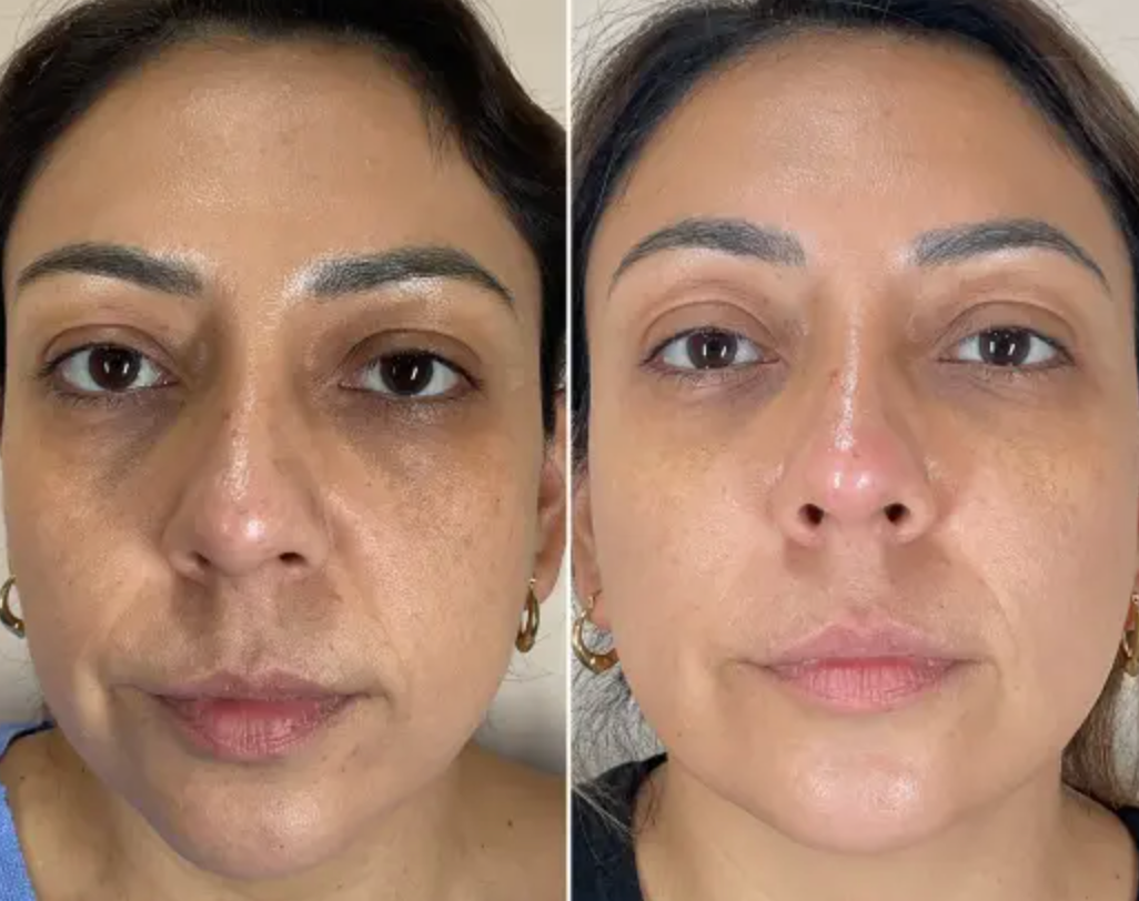 TENSOR FACIAL INSTANTANEO 8 en 1 CON ÁCIDO HIALURONICO